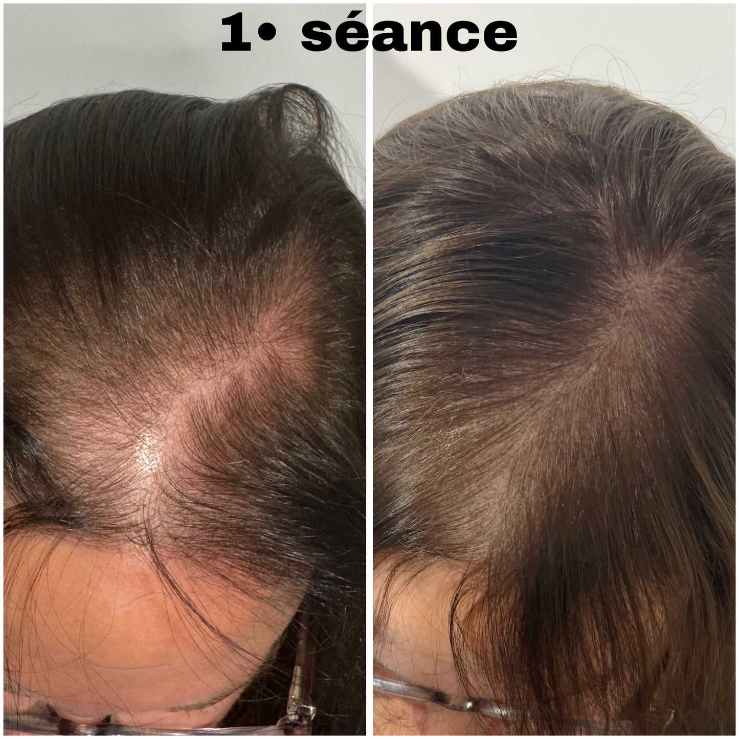 Micro pigmentation Capillaire